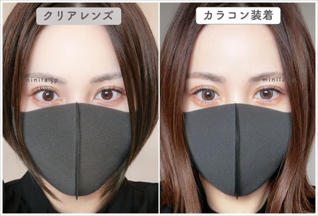 フェードラインレポ装着画像引きで裸眼比較